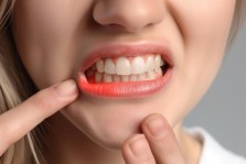 Gingivitis Nedir?